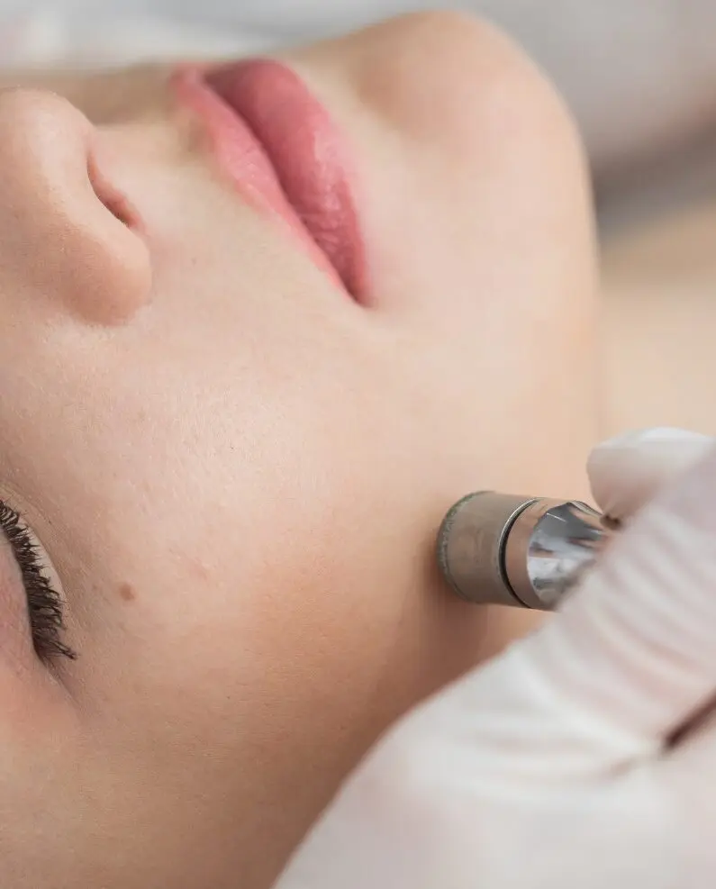 Microdermabrasion-in-Aachen-by-Lima-Beauty